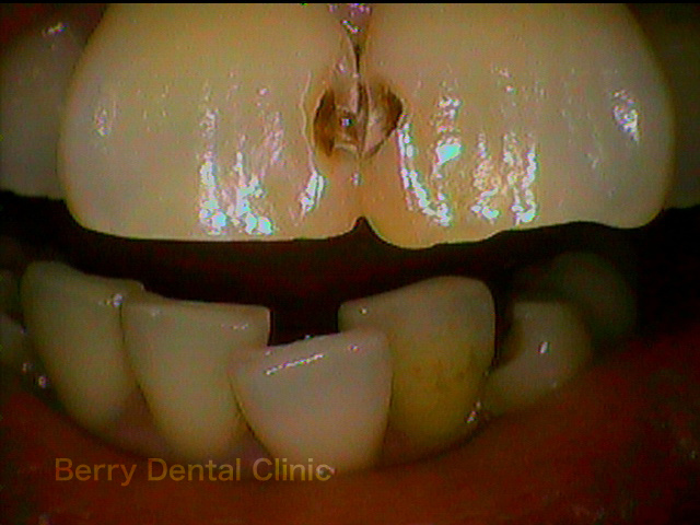 前歯の虫歯 歯の歯の間の黒い虫歯 船橋 歯医者 ベリーデンタルクリニック 土日も診察